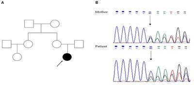 Case Report: A Case of Concomitant Paroxysmal Kinesigenic Dyskinesia and Epilepsy: Can We Treat Two Birds With One Stone?